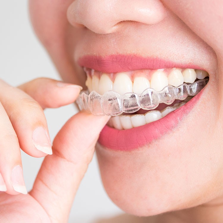 הטיפולים שלנו בקשתיות שקופות ליישור שיניים